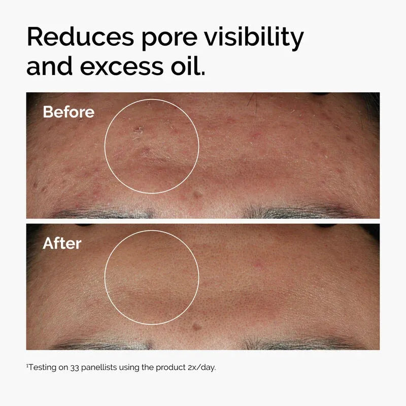 Niacinamide Serum - Niacinamide 10% Zinc 1%